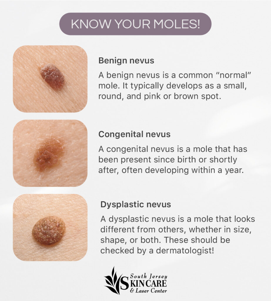 Mole Removal in New Jersey | South Jersey Skin Care & Laser