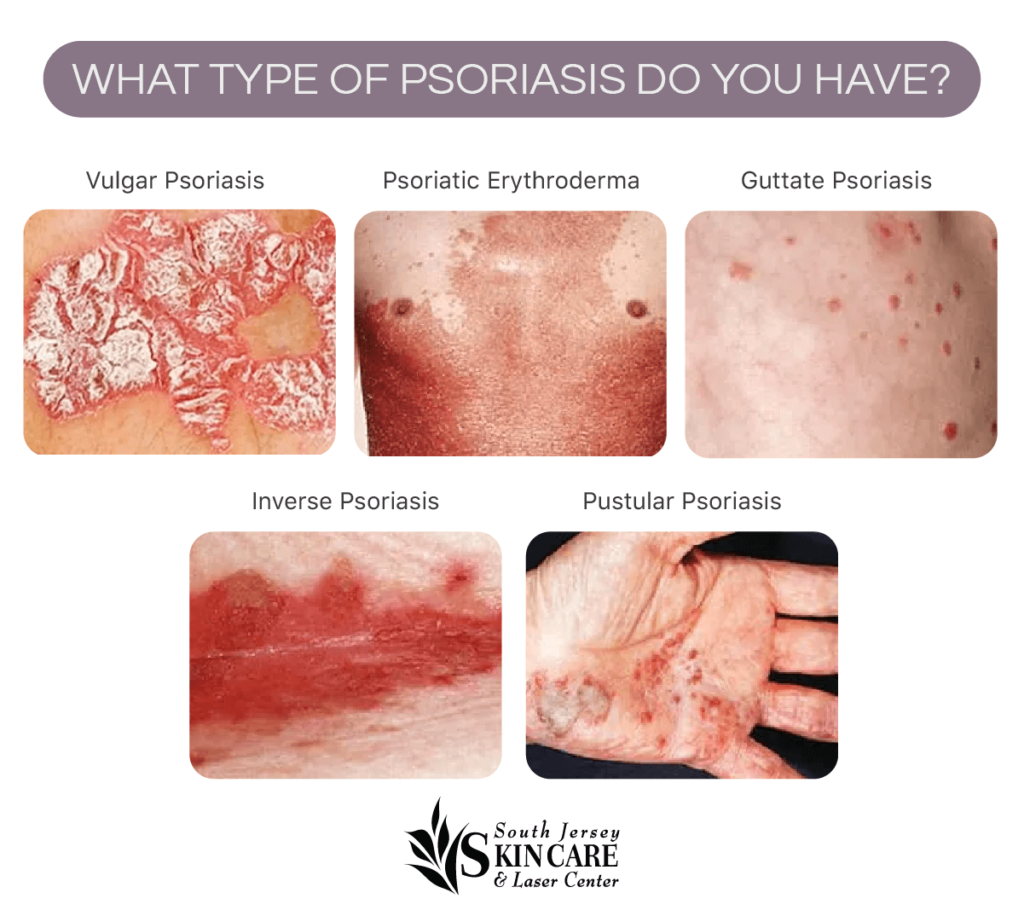 Psoriasis | New Jersey | South Jersey Skin Care & Laser Center